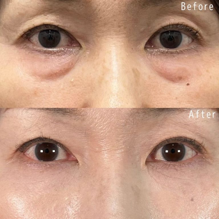 切らない目の下のクマ取り・目の下のたるみ（ふくらみ）取り(担当医:佐野 孝治 医師)の症例写真1