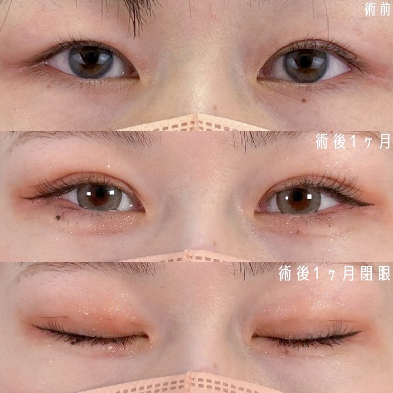 二重埋没法(担当医:佐野 孝治 医師)の症例写真1