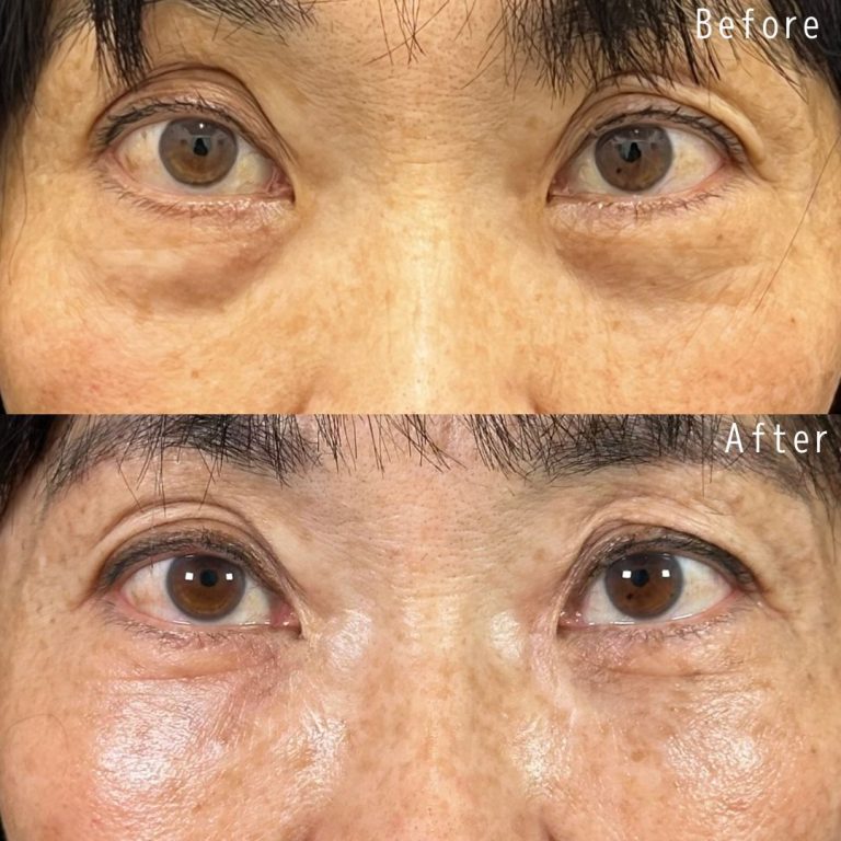 切らない目の下のクマ取り・目の下のたるみ（ふくらみ）取り(担当医:佐野 孝治 医師)の症例写真1