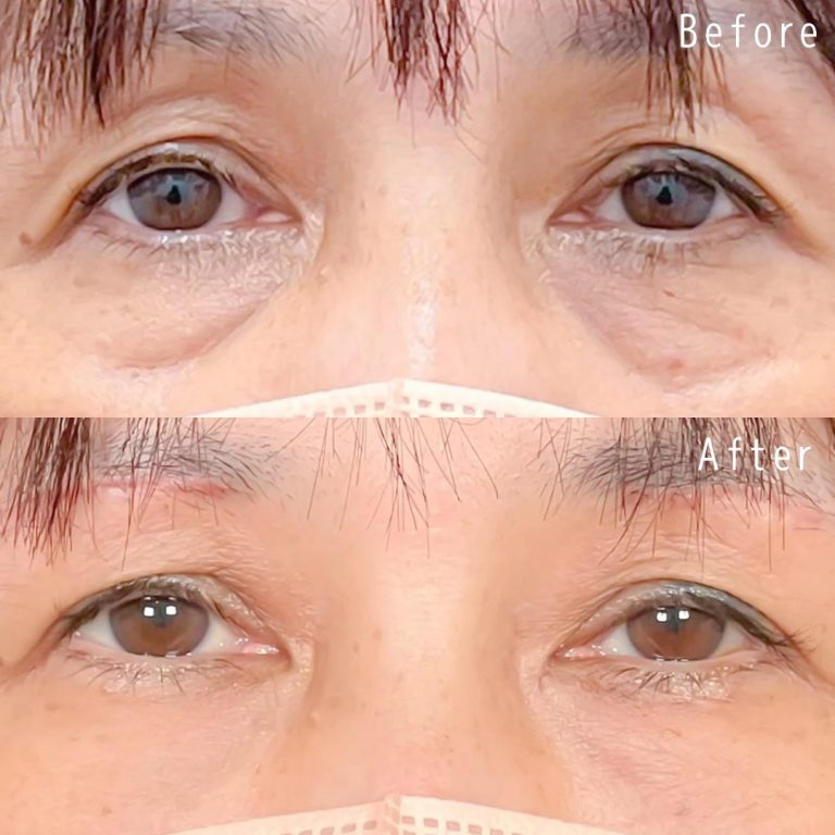 切らない目の下のクマ取り・目の下のたるみ（ふくらみ）取り(担当医:佐野 孝治 医師)の症例写真1