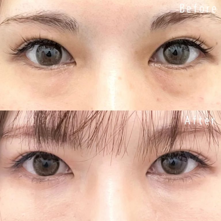 切らない目の下のクマ取り・目の下のたるみ（ふくらみ）取り(担当医:佐野 孝治 医師)の症例写真1