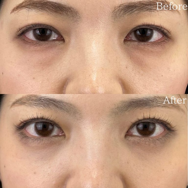 切らない目の下のクマ取り・目の下のたるみ（ふくらみ）取り(担当医:佐野 孝治 医師)の症例写真1