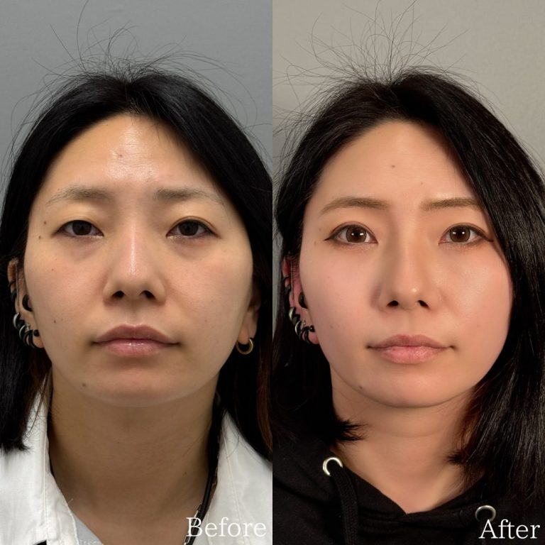 切らない目の下のクマ取り・目の下のたるみ（ふくらみ）取り(担当医:佐野 孝治 医師)の症例写真1