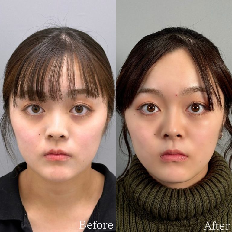 切らない目の下のクマ取り・目の下のたるみ（ふくらみ）取り(担当医:佐野 孝治 医師)の症例写真1