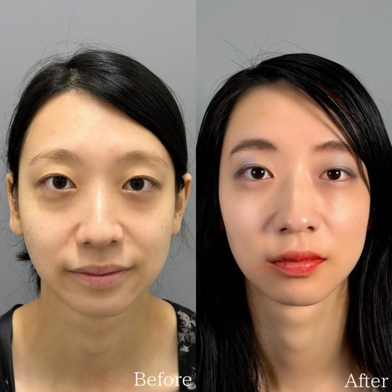 切らない目の下のクマ取り・目の下のたるみ（ふくらみ）取り(担当医:佐野 孝治 医師)の症例写真1