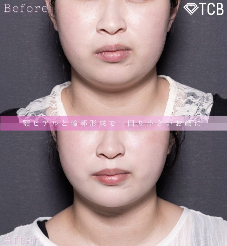 顔の脂肪吸引(担当医:北村 可恋 医師)の症例写真1