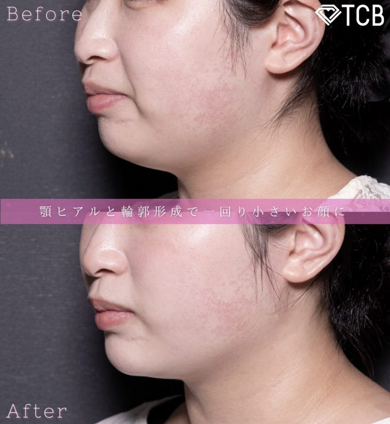 顔の脂肪吸引(担当医:北村 可恋 医師)の症例写真2
