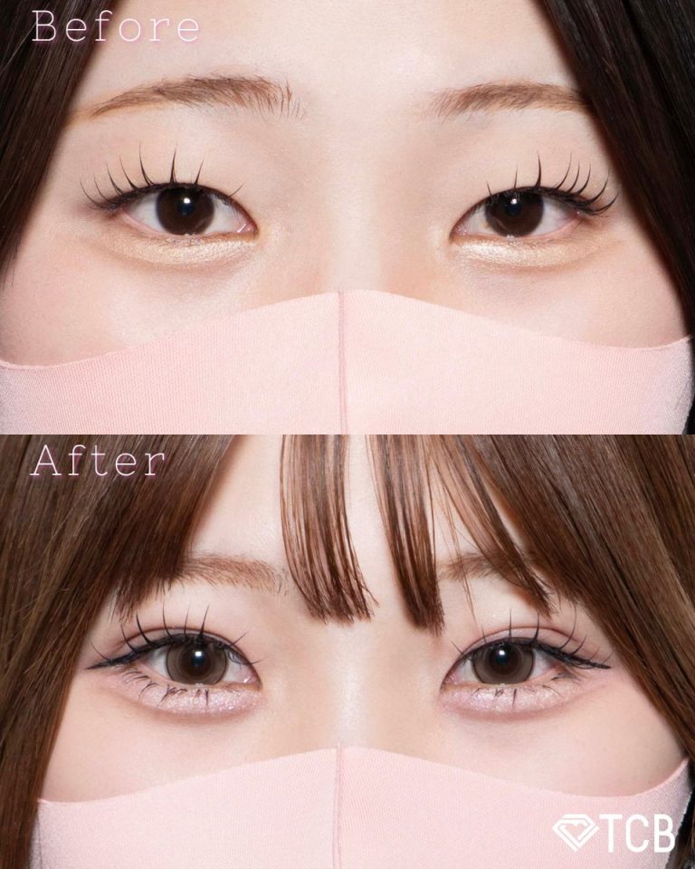 二重埋没法(担当医:北村 可恋 医師)の症例写真1