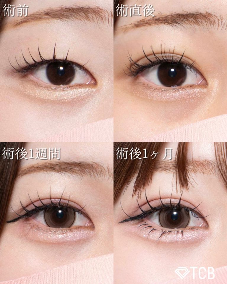 二重埋没法(担当医:北村 可恋 医師)の症例写真2