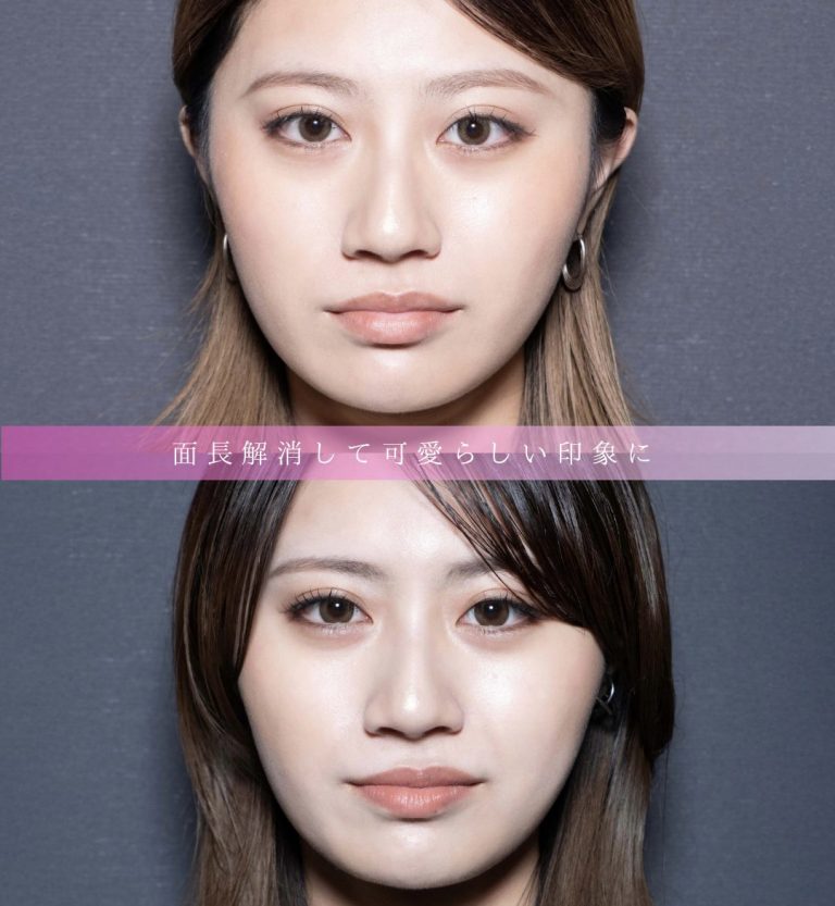 小顔美肌再生（リフトアップ）(担当医:北村 可恋 医師)の症例写真1