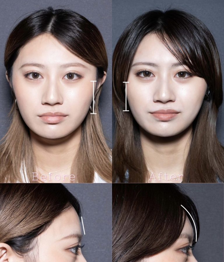 小顔美肌再生（リフトアップ）(担当医:北村 可恋 医師)の症例写真2