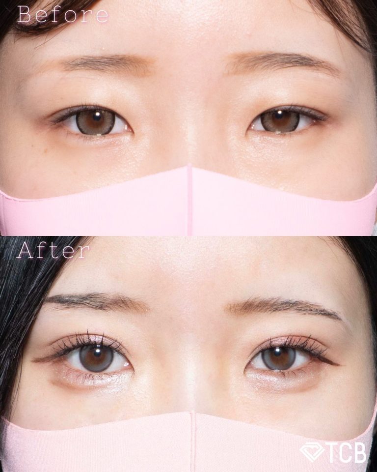 二重埋没法(担当医:北村 可恋 医師)の症例写真1