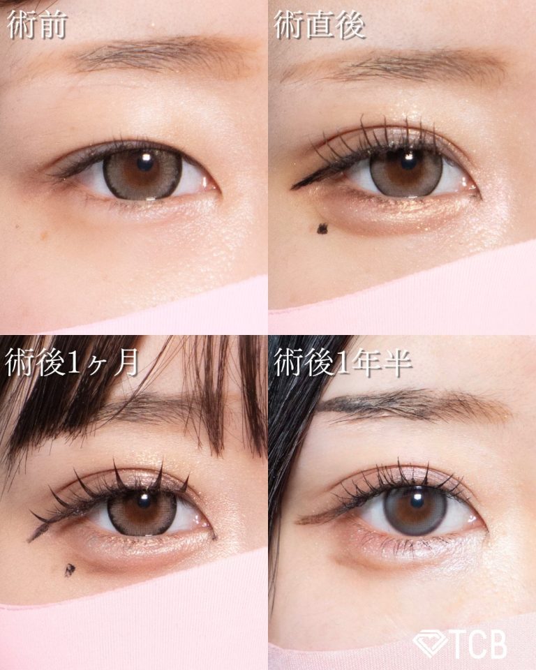 二重埋没法(担当医:北村 可恋 医師)の症例写真2