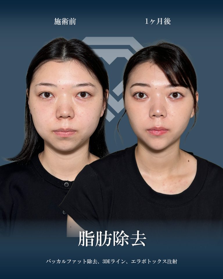 バッカルファット除去(担当医:大見 貴秀 医師)の症例写真1