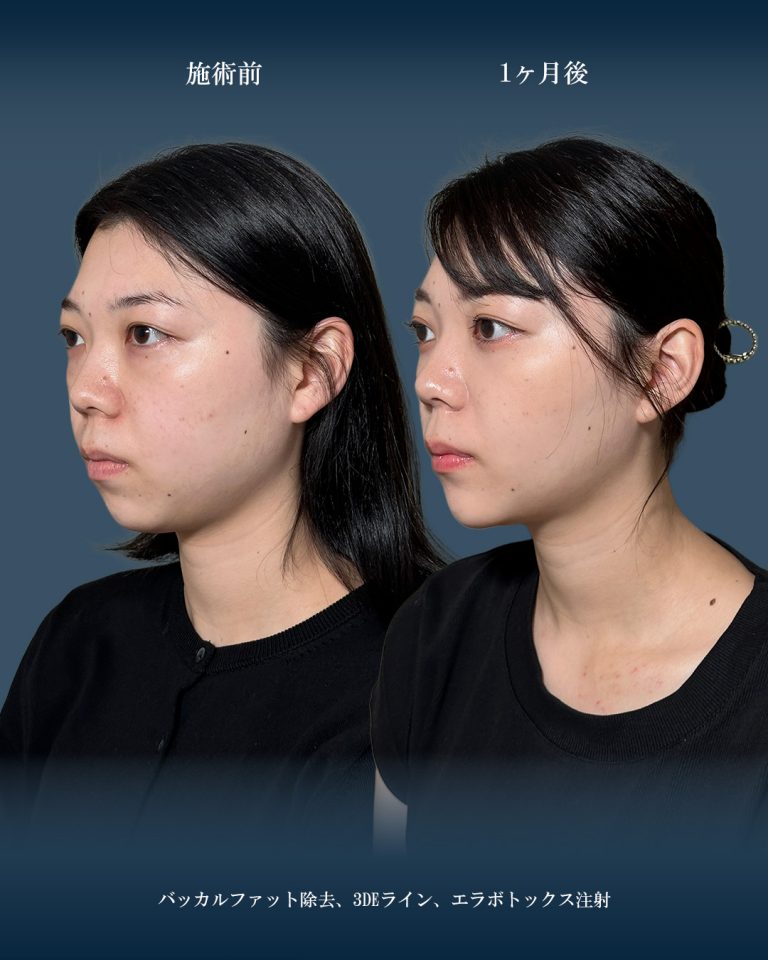 バッカルファット除去(担当医:大見 貴秀 医師)の症例写真2