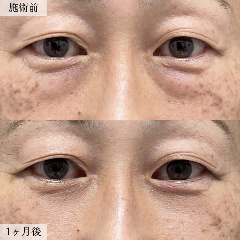 切らない目の下のクマ取り・目の下のたるみ（ふくらみ）取り(担当医:大見 貴秀 医師)の症例写真1