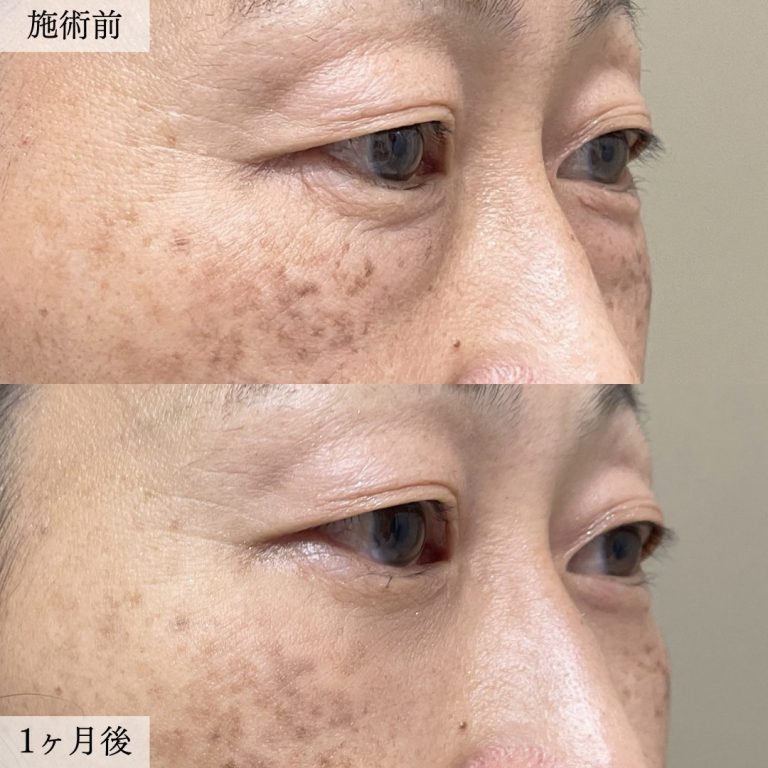 切らない目の下のクマ取り・目の下のたるみ（ふくらみ）取り(担当医:大見 貴秀 医師)の症例写真2