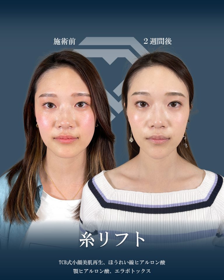 小顔美肌再生（リフトアップ）(担当医:大見 貴秀 医師)の症例写真1