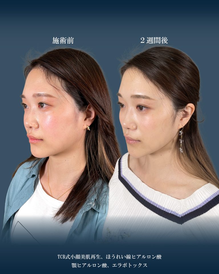 小顔美肌再生（リフトアップ）(担当医:大見 貴秀 医師)の症例写真2