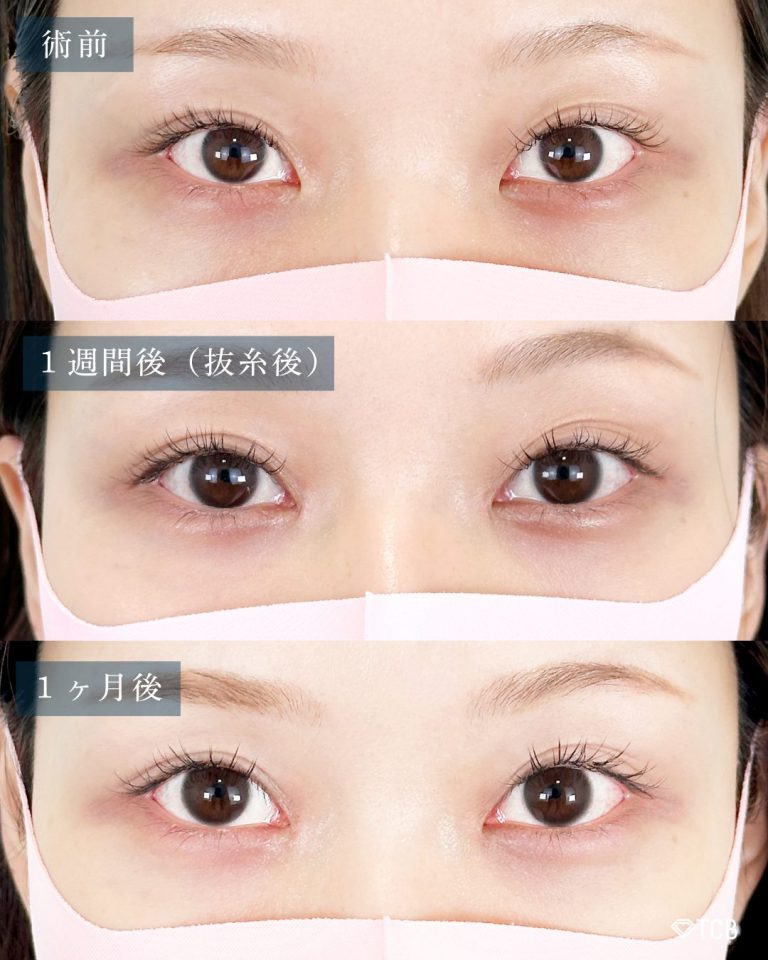 目頭切開(担当医:向田 敦史 医師)の症例写真2