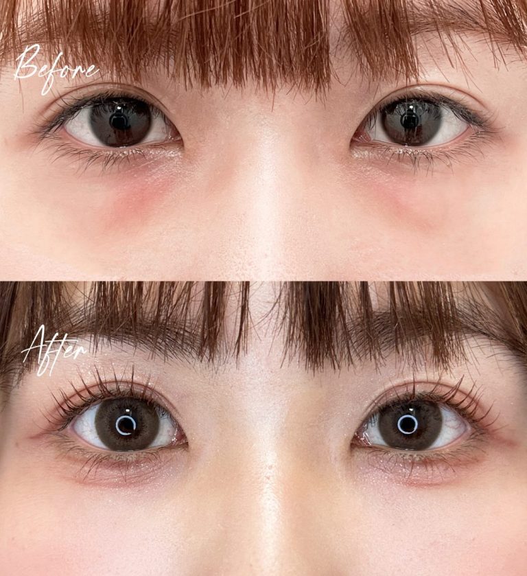 切らない目の下のクマ取り・目の下のたるみ（ふくらみ）取り(担当医:向田 敦史 医師)の症例写真1