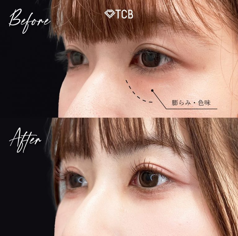 切らない目の下のクマ取り・目の下のたるみ（ふくらみ）取り(担当医:向田 敦史 医師)の症例写真2