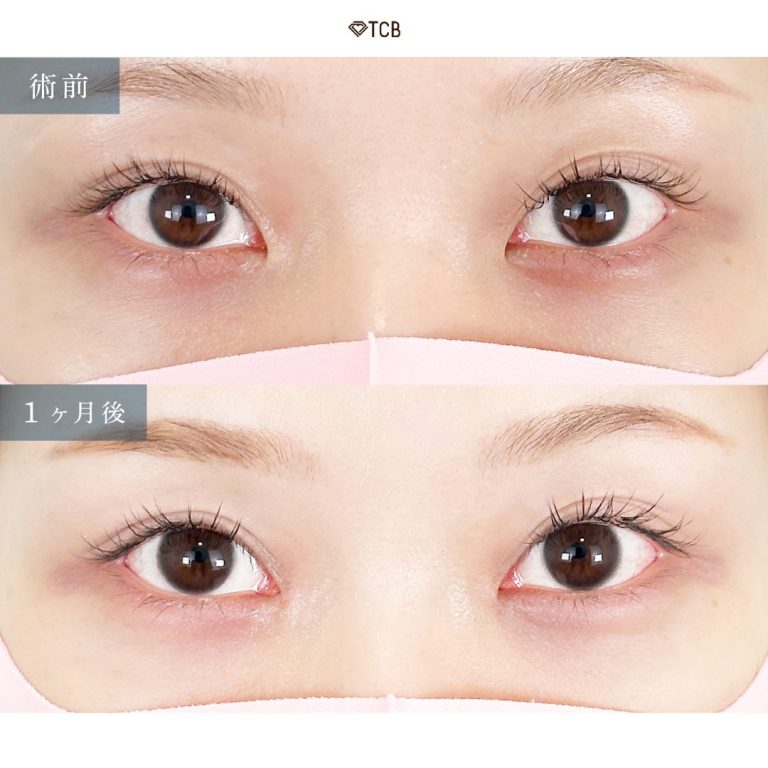 目頭切開(担当医:向田 敦史 医師)の症例写真1