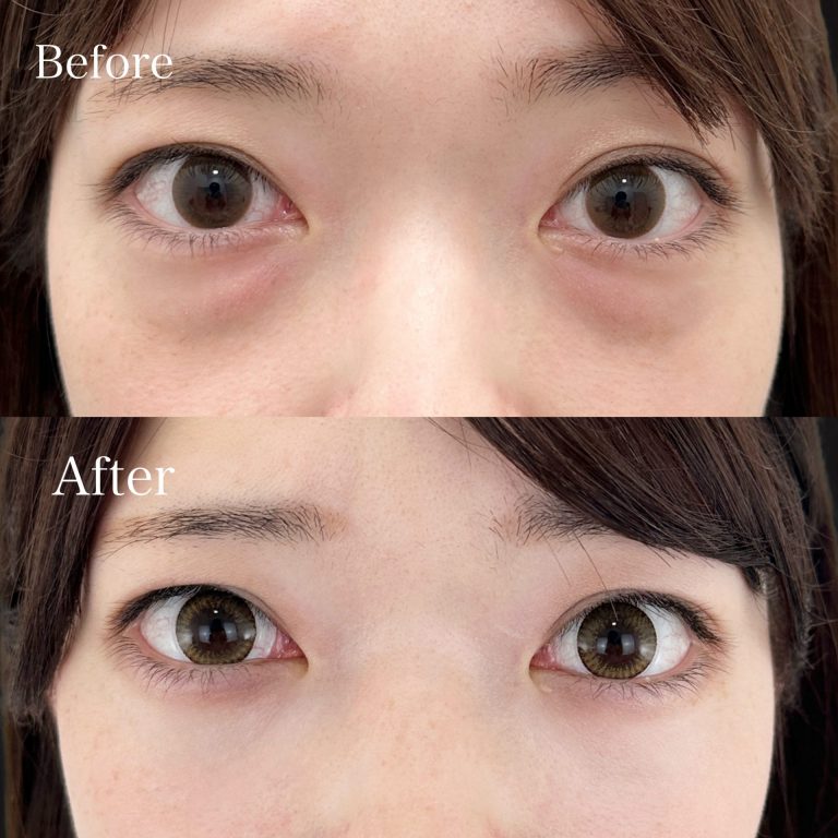 切らない目の下のクマ取り・目の下のたるみ（ふくらみ）取り(担当医:向田 敦史 医師)の症例写真1