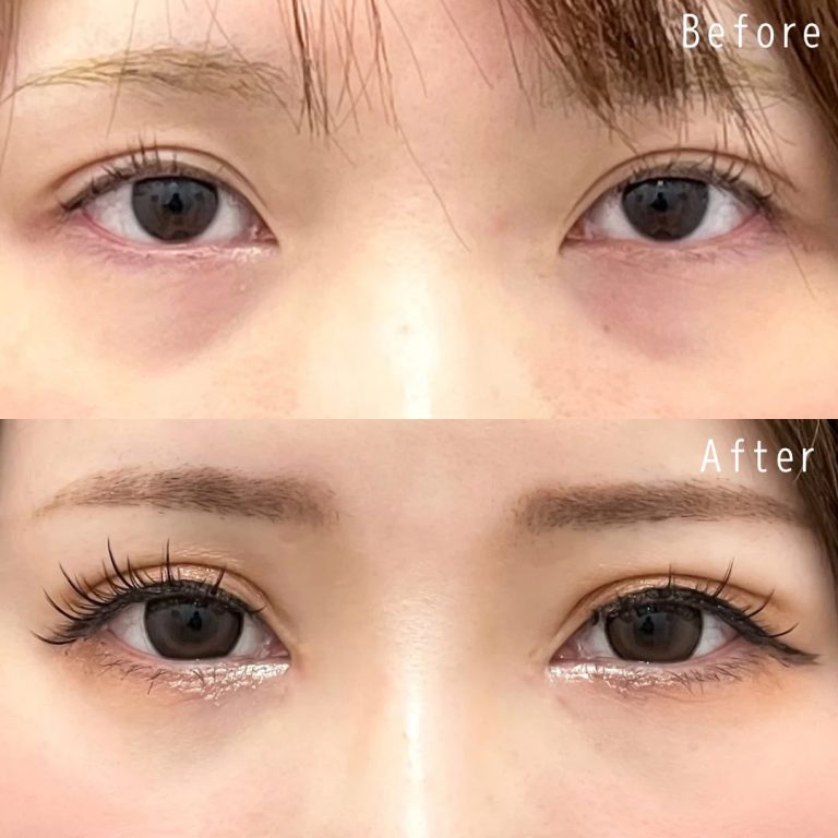 切らない目の下のクマ取り・目の下のたるみ（ふくらみ）取り(担当医:佐野 孝治 医師)の症例写真1