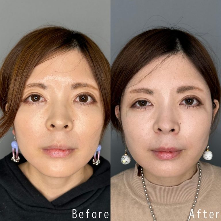 鼻尖形成(担当医:佐野 孝治 医師)の症例写真1