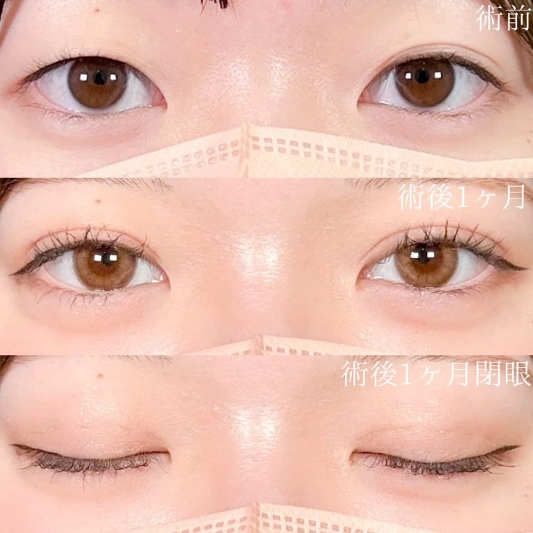 二重埋没法(担当医:佐野 孝治 医師)の症例写真1