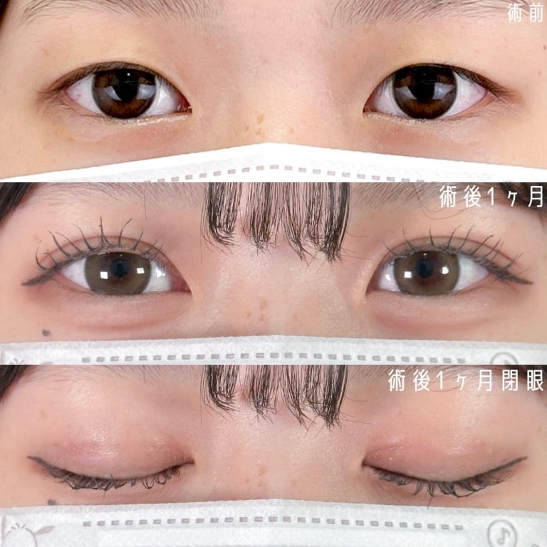 二重埋没法(担当医:佐野 孝治 医師)の症例写真1