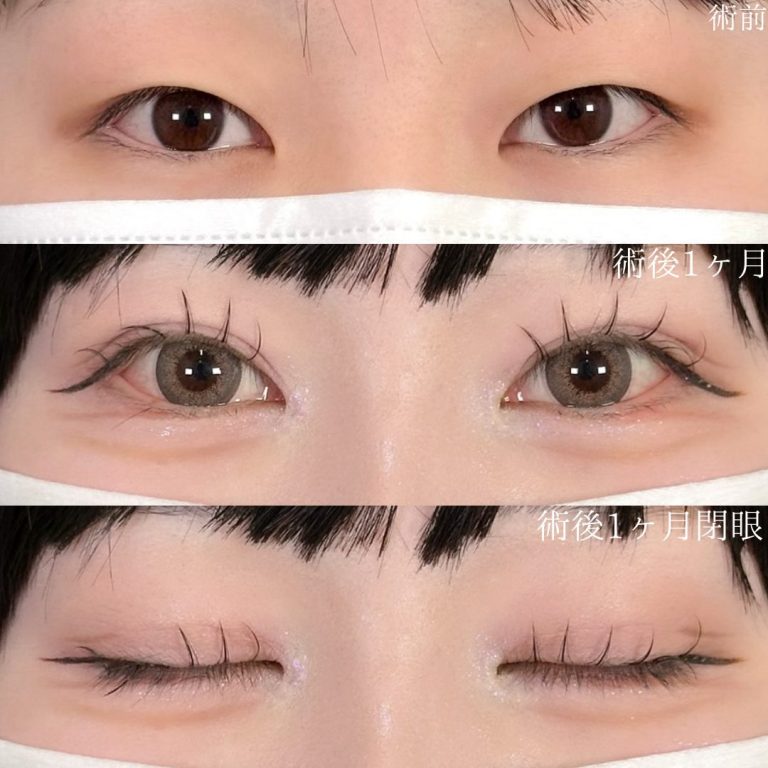 二重埋没法(担当医:佐野 孝治 医師)の症例写真1