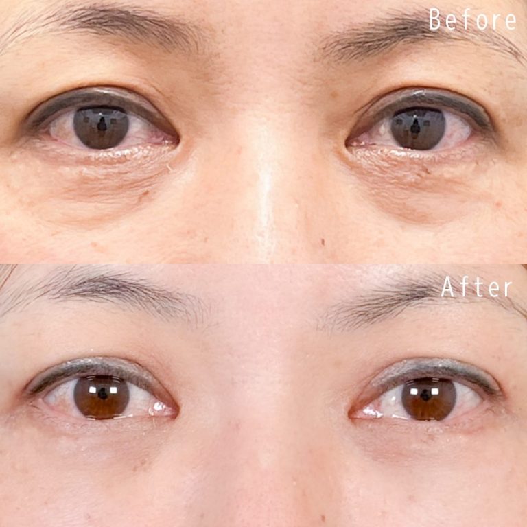 切らない目の下のクマ取り・目の下のたるみ（ふくらみ）取り(担当医:佐野 孝治 医師)の症例写真1