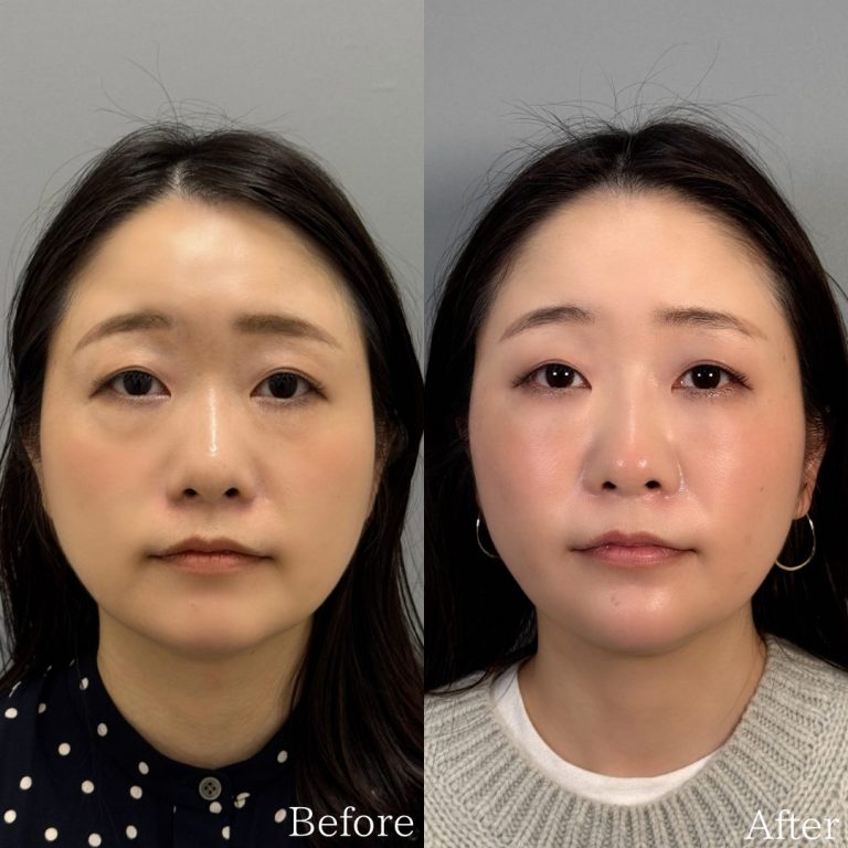 切らない目の下のクマ取り・目の下のたるみ（ふくらみ）取り(担当医:佐野 孝治 医師)の症例写真1