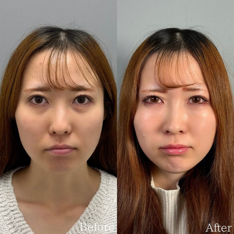 切らない目の下のクマ取り・目の下のたるみ（ふくらみ）取り(担当医:佐野 孝治 医師)の症例写真1