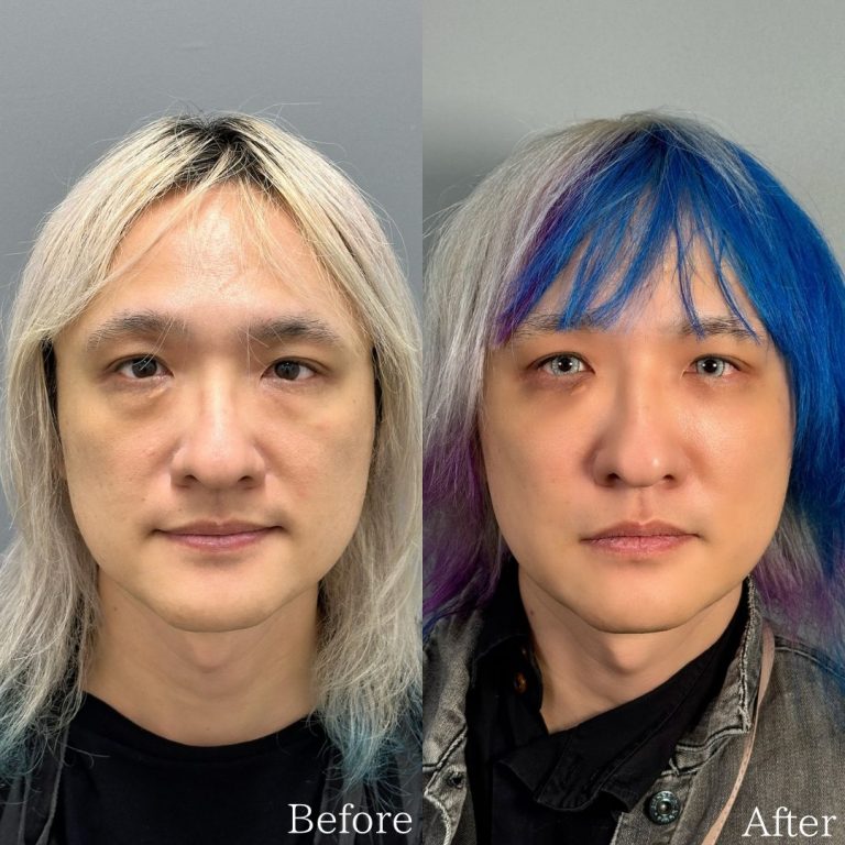 切らない目の下のクマ取り・目の下のたるみ（ふくらみ）取り(担当医:佐野 孝治 医師)の症例写真1