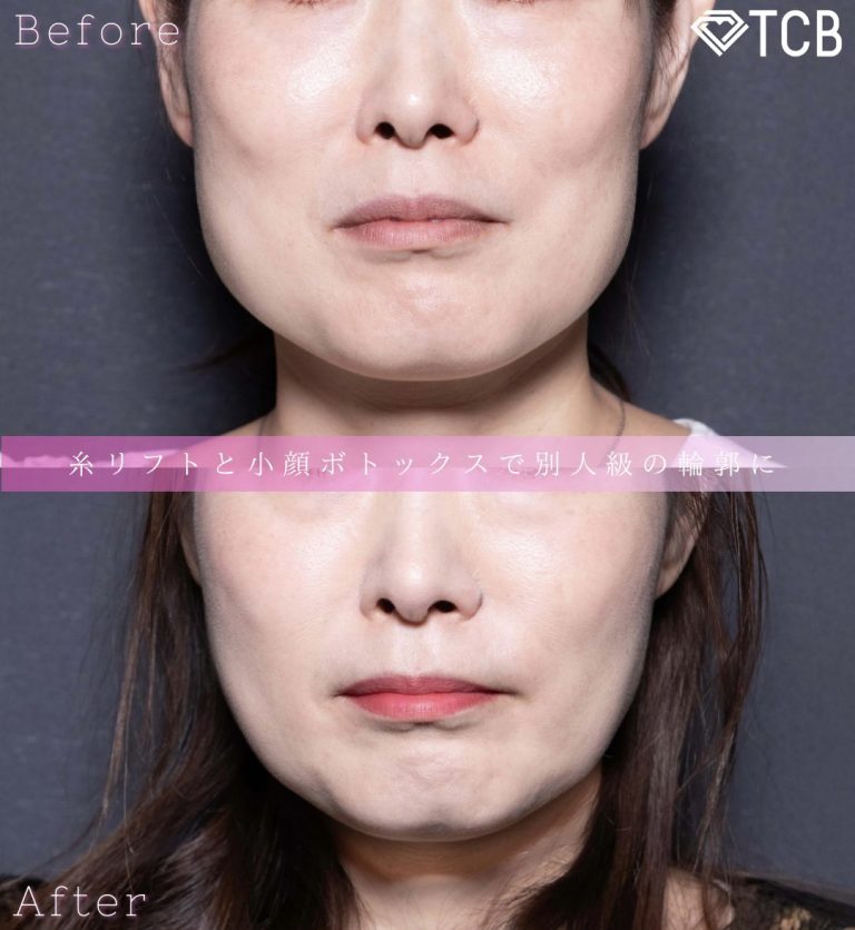 小顔美肌再生（リフトアップ）(担当医:北村 可恋 医師)の症例写真1