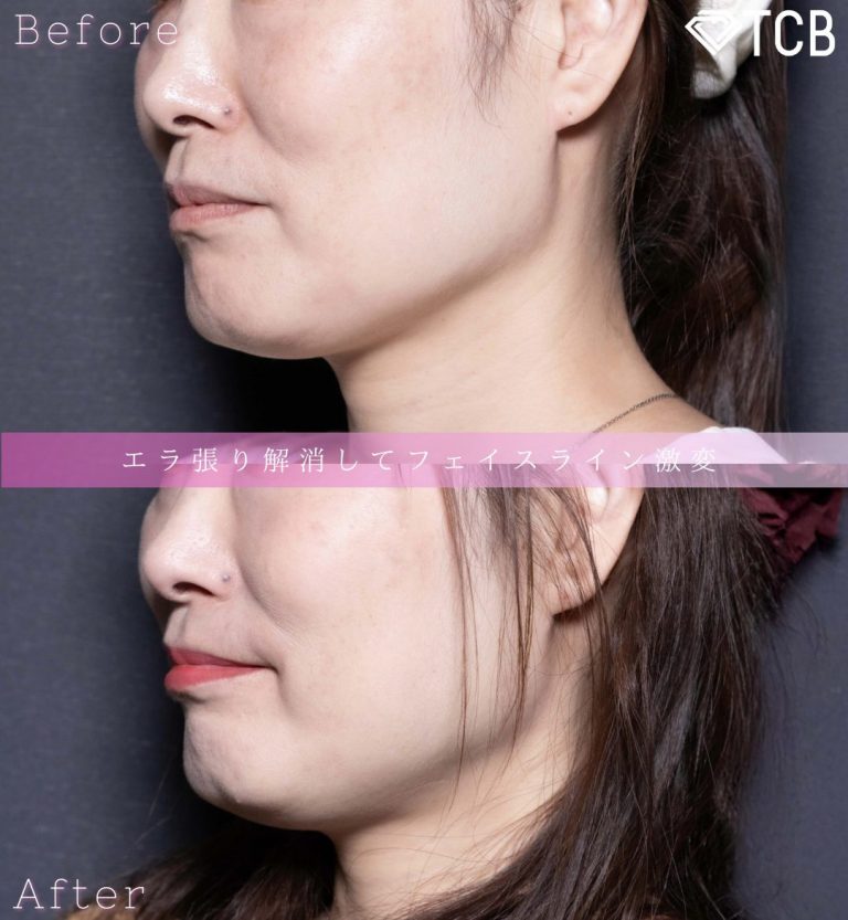 小顔美肌再生（リフトアップ）(担当医:北村 可恋 医師)の症例写真2