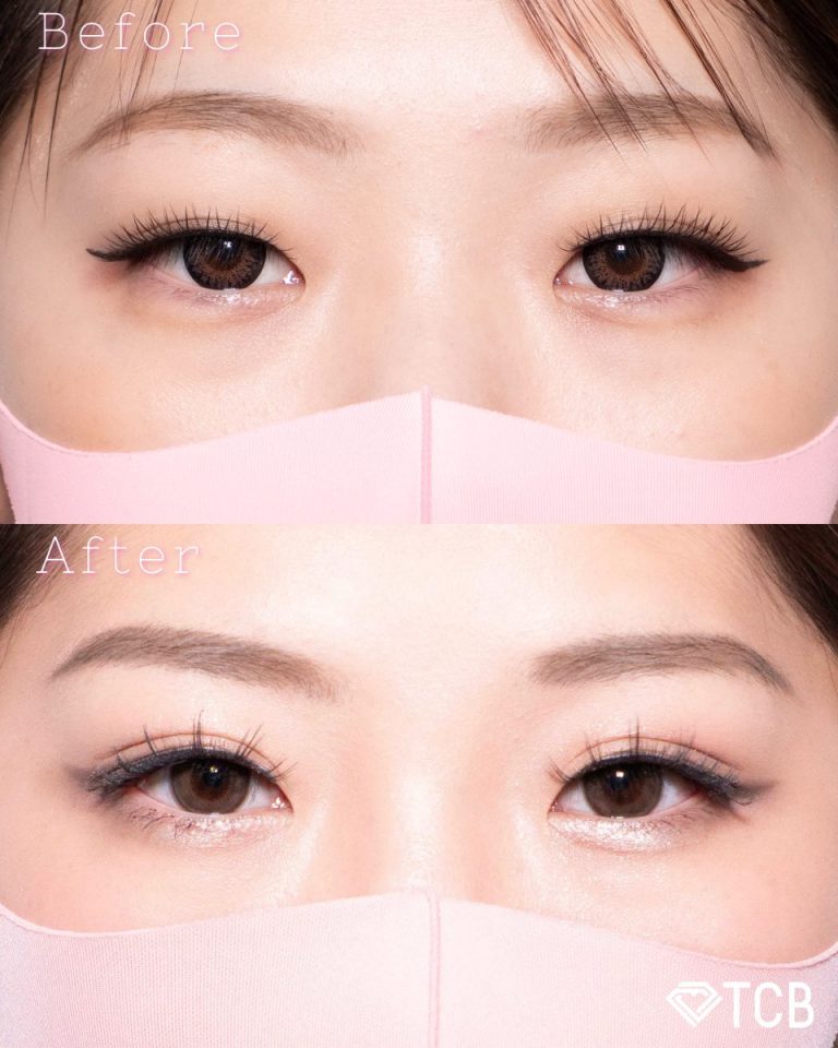 二重埋没法(担当医:北村 可恋 医師)の症例写真1