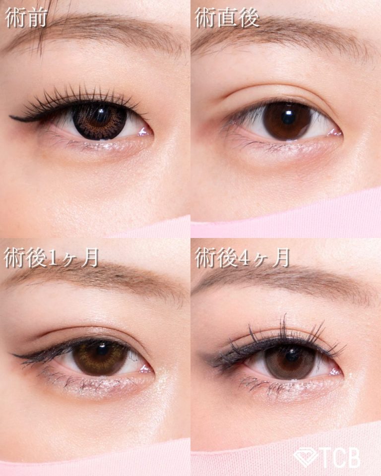 二重埋没法(担当医:北村 可恋 医師)の症例写真2