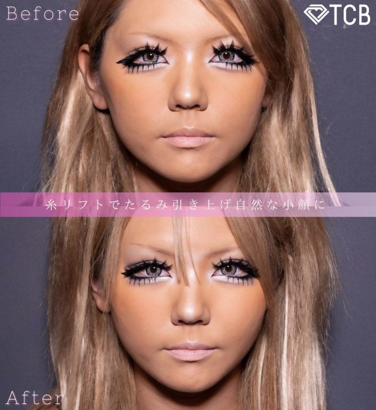 小顔美肌再生（リフトアップ）(担当医:北村 可恋 医師)の症例写真1