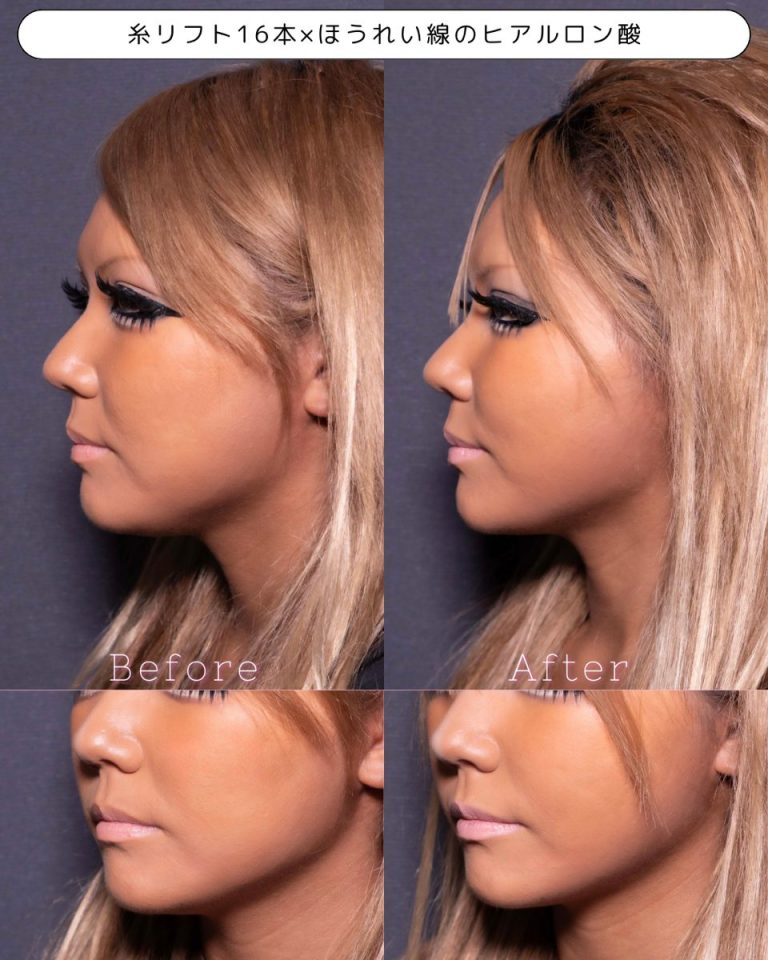 小顔美肌再生（リフトアップ）(担当医:北村 可恋 医師)の症例写真2