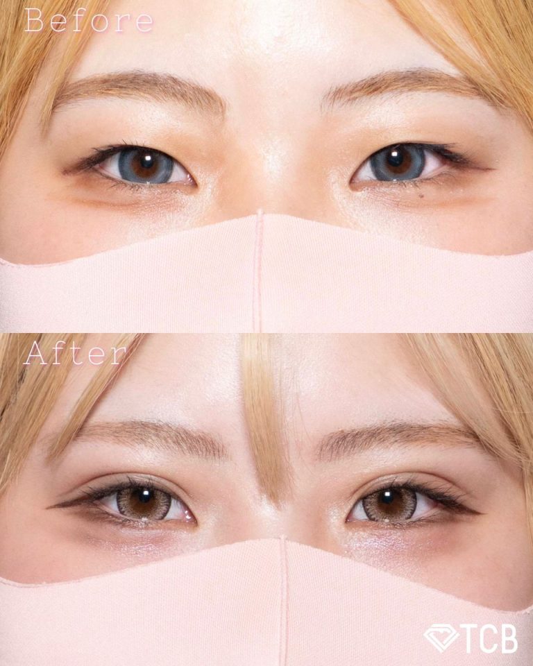 二重埋没法(担当医:北村 可恋 医師)の症例写真1