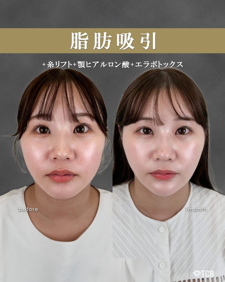 顔の脂肪吸引(担当医:富田 秀鷹 医師)の症例写真1