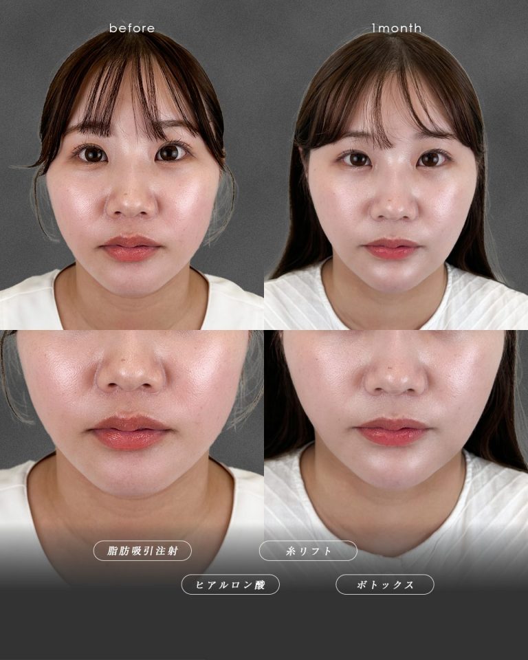 顔の脂肪吸引(担当医:富田 秀鷹 医師)の症例写真2