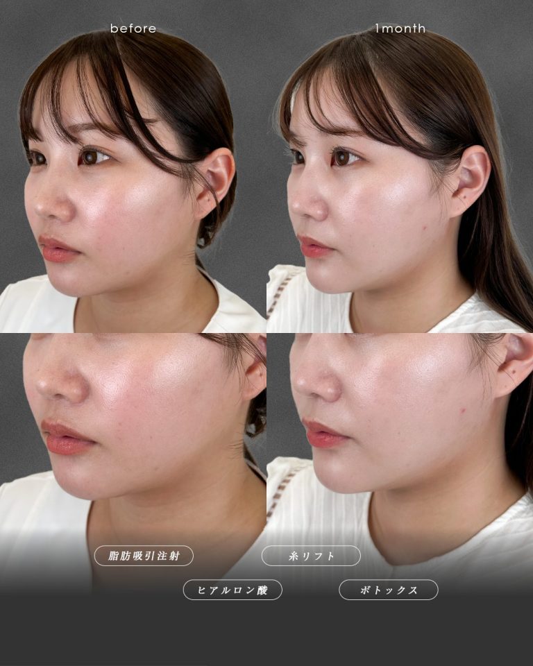 顔の脂肪吸引(担当医:富田 秀鷹 医師)の症例写真3