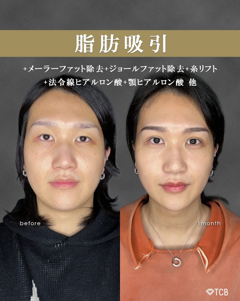 顔の脂肪吸引(担当医:富田 秀鷹 医師)の症例写真1