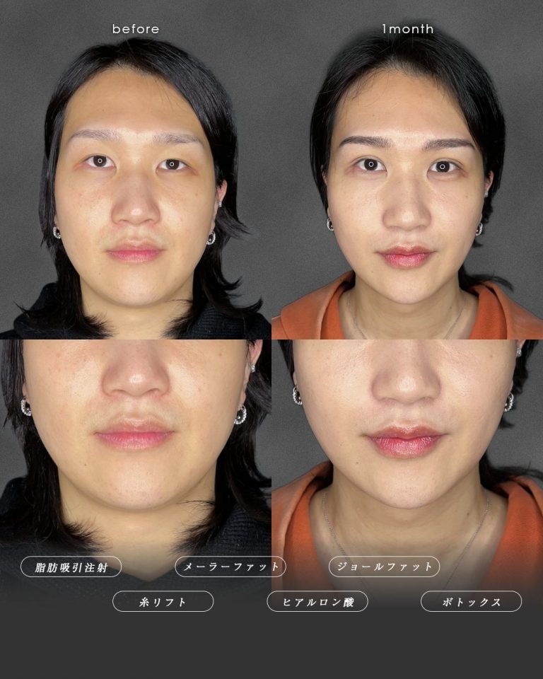 顔の脂肪吸引(担当医:富田 秀鷹 医師)の症例写真3