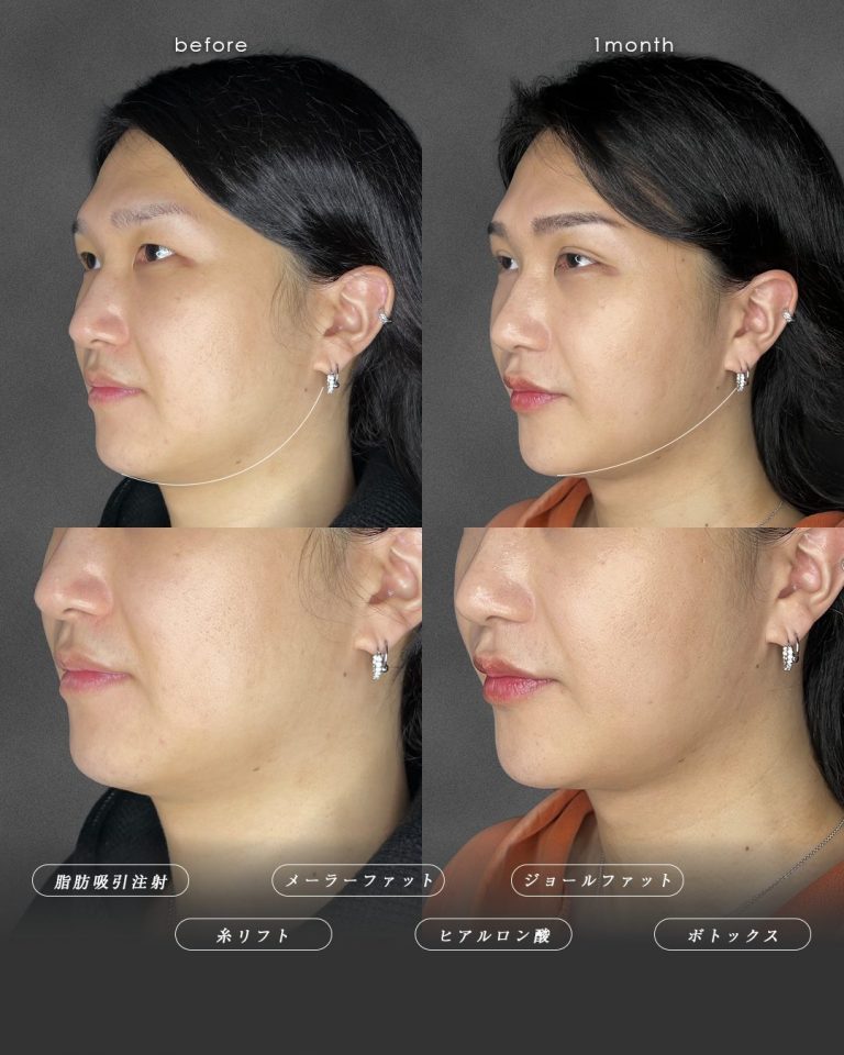 顔の脂肪吸引(担当医:富田 秀鷹 医師)の症例写真2
